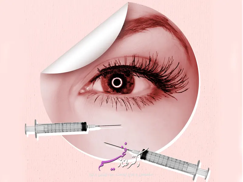 تزریق ژل زیر چشم