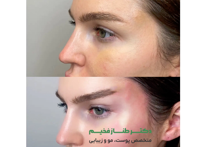 عکس قبل و بعد لیفت ابرو با نخ