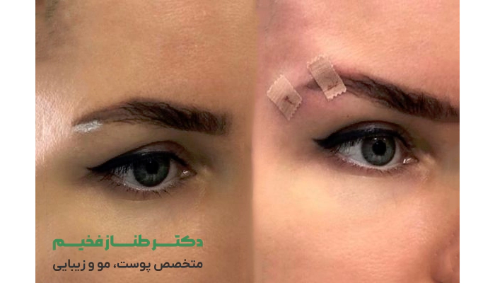 مزایا، معایب و عوارض لیفت ابرو با نخ