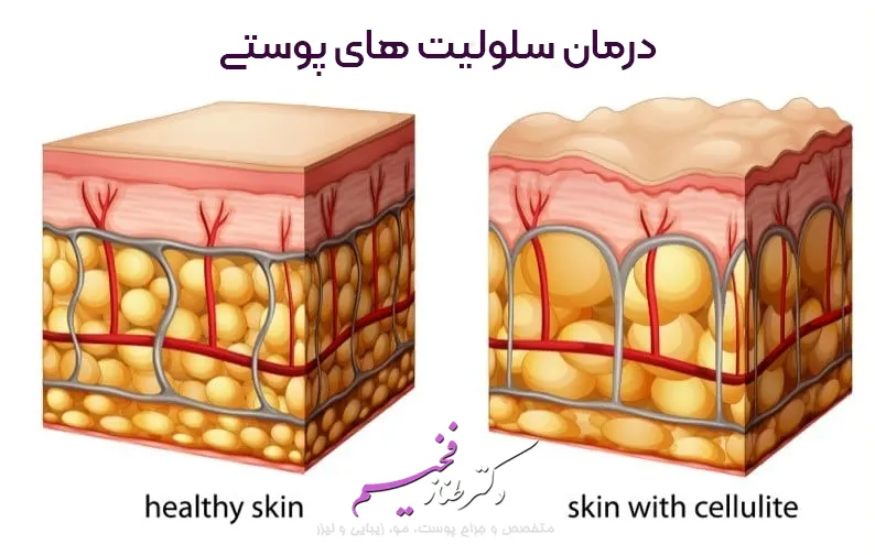 درمان سلولیت های پوستی
