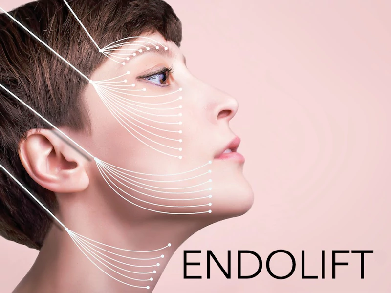 بهترین دکتر اندولیفت (Endolift) صورت در تهران کیست؟