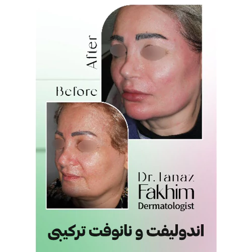 نمونه کار اندولیفت دکتر فخیم